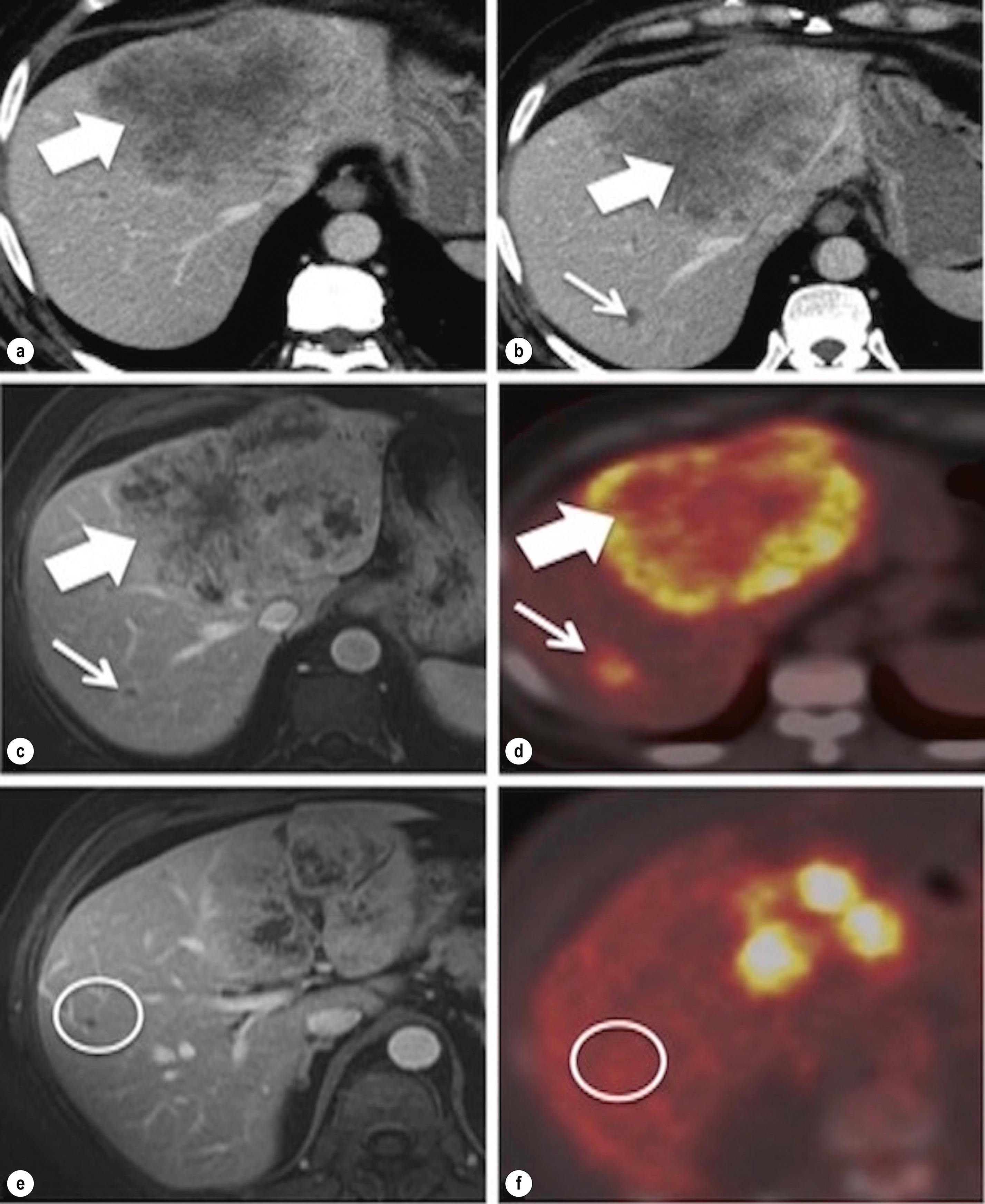 Figure 7.3, (a) Portal venous phase contrast-enhanced liver CT: necrotic mass, with fibrous enhancement centred on segments 2–4 (thick arrow) ; (b) a second hypodense lesion on CT scan is visible in segment 7 (thin arrow) ; (c) MRI shows peripheral enhancement of both lesions (arrows) ; (d) both lesions are hypermetabolic on PET-CT (arrows) ; (e) discovery of an additional lesion on portal venous phase contrast-enhanced MRI (circle) ; (f) this third lesion was not seen on CT or PET-CT (circle) . CT, computed tomography; MRI, magnetic resonance imaging; PET, positron emission tomography.