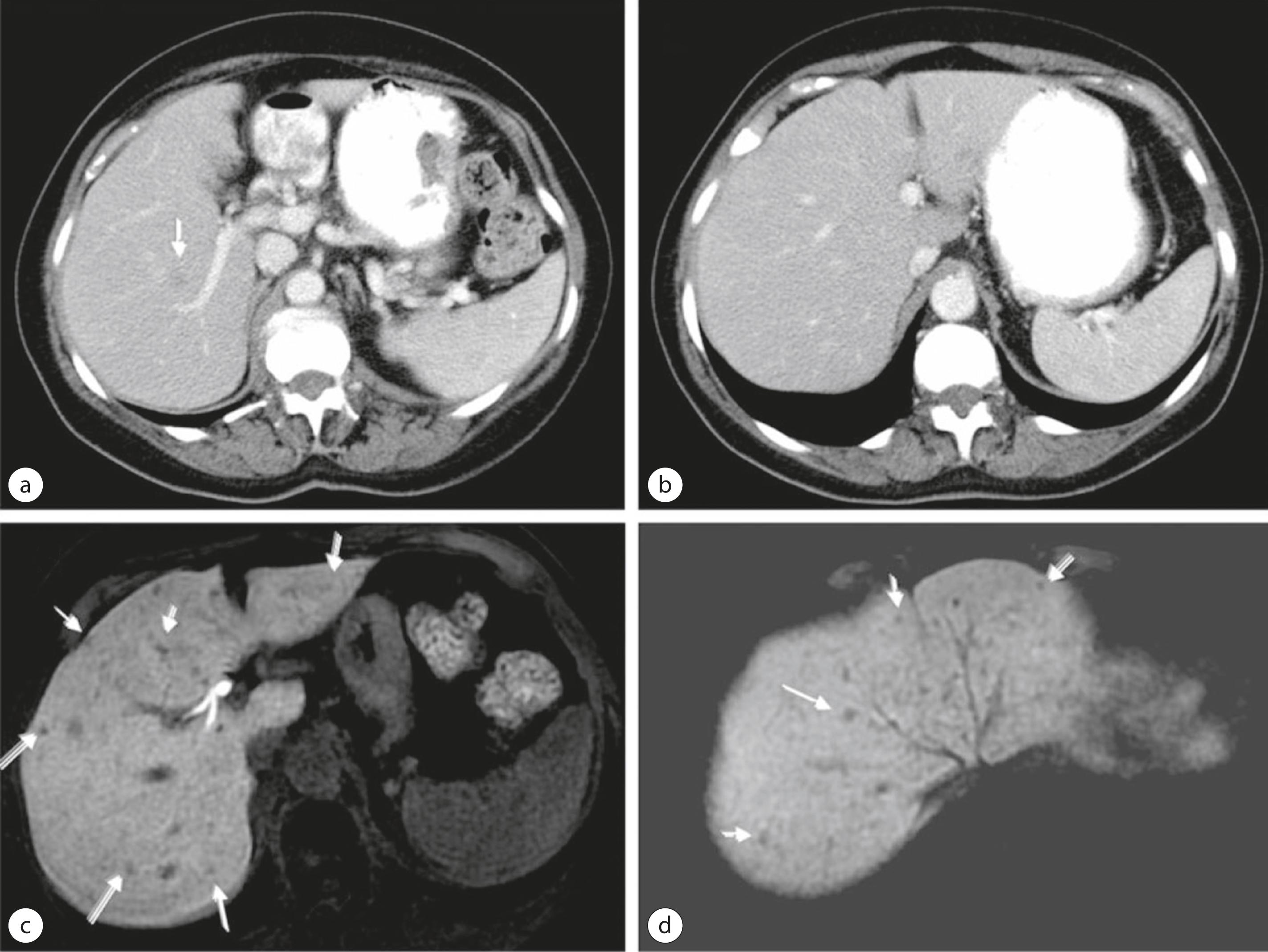 Figure 7.4, A 44-year-old man, with stage III colon cancer who underwent resection 1 year previously followed by adjuvant chemotherapy. Follow-up restaging CT (a, b) showed reduced liver attenuation in comparison with spleen due to steatosis and a possible lesion in the right lobe (arrow) . Liver MRI was performed with hepatobiliary contrast agent Eovist. On 10-minute delayed hepatobiliary phase, T1-weighted fat saturation MR images (c, d) demonstrate enhancing liver parenchyma and numerous non-enhancing, small metastases scattered within the right and left lobe of liver (arrows) . CT, computed tomography; MRI, magnetic resonance imaging.