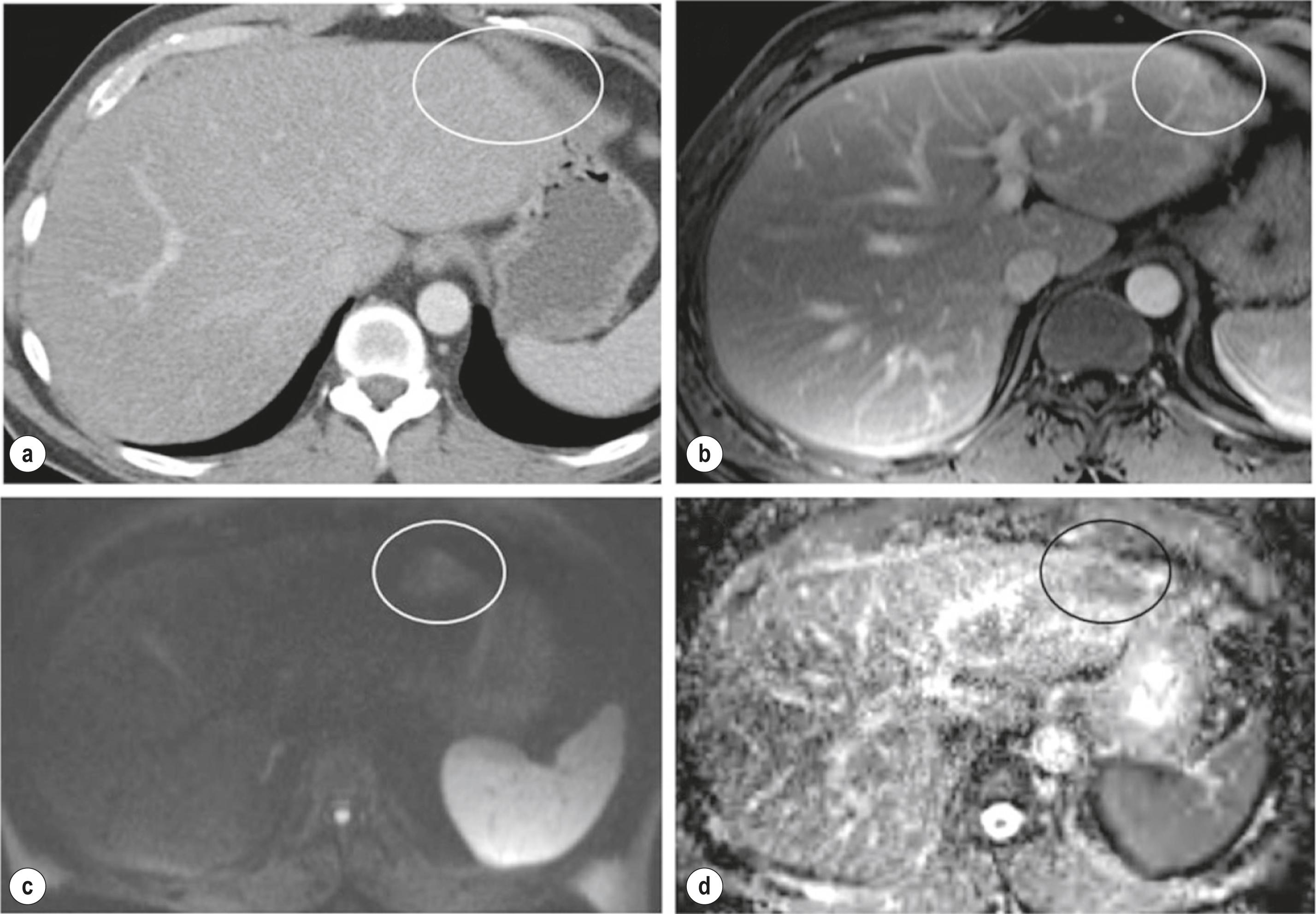 Figure 7.5, A 51-year-old man with colorectal liver metastases receiving chemotherapy. Follow-up CT (a) and MRI (b) failed to demonstrate left lateral section metastasis that is more obvious on diffusion-weighted MRI (c) as a focal bright area with associated restricted diffusion on apparent diffusion coefficient image (d) . CT, computed tomography; MRI, magnetic resonance imaging.