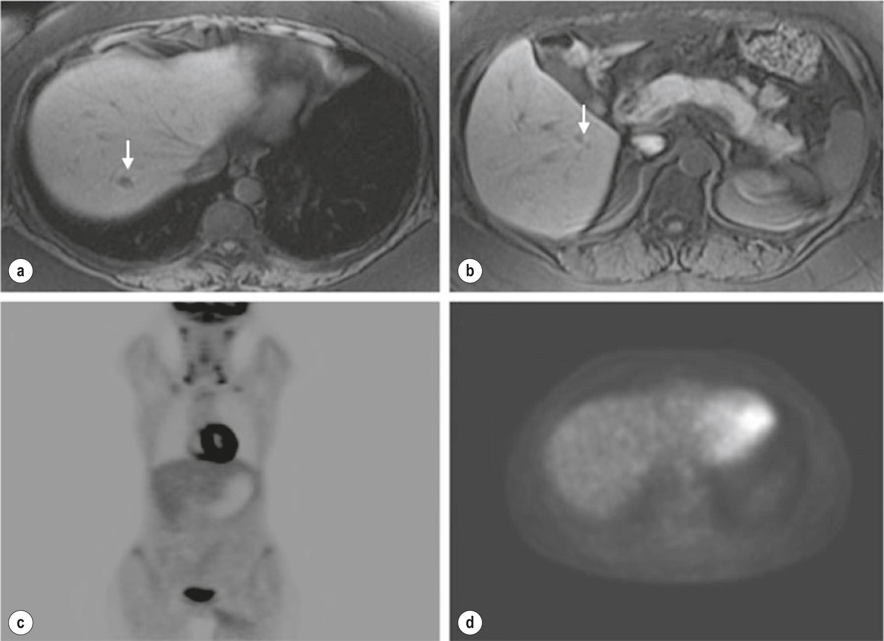 Figure 7.6, Small colorectal liver metastasis without increased FDG uptake in a 47-year-old woman. MRI of the liver shows two small metastatic deposits (arrow) in the right liver (a, b) . Representative coronal and axial images from a whole-body FDG-PET examination (c, d) show no corresponding focal increased FDG uptake in the liver. FDG, fluorodeoxyglucose; MRI, magnetic resonance imaging; PET, positron emission tomography.
