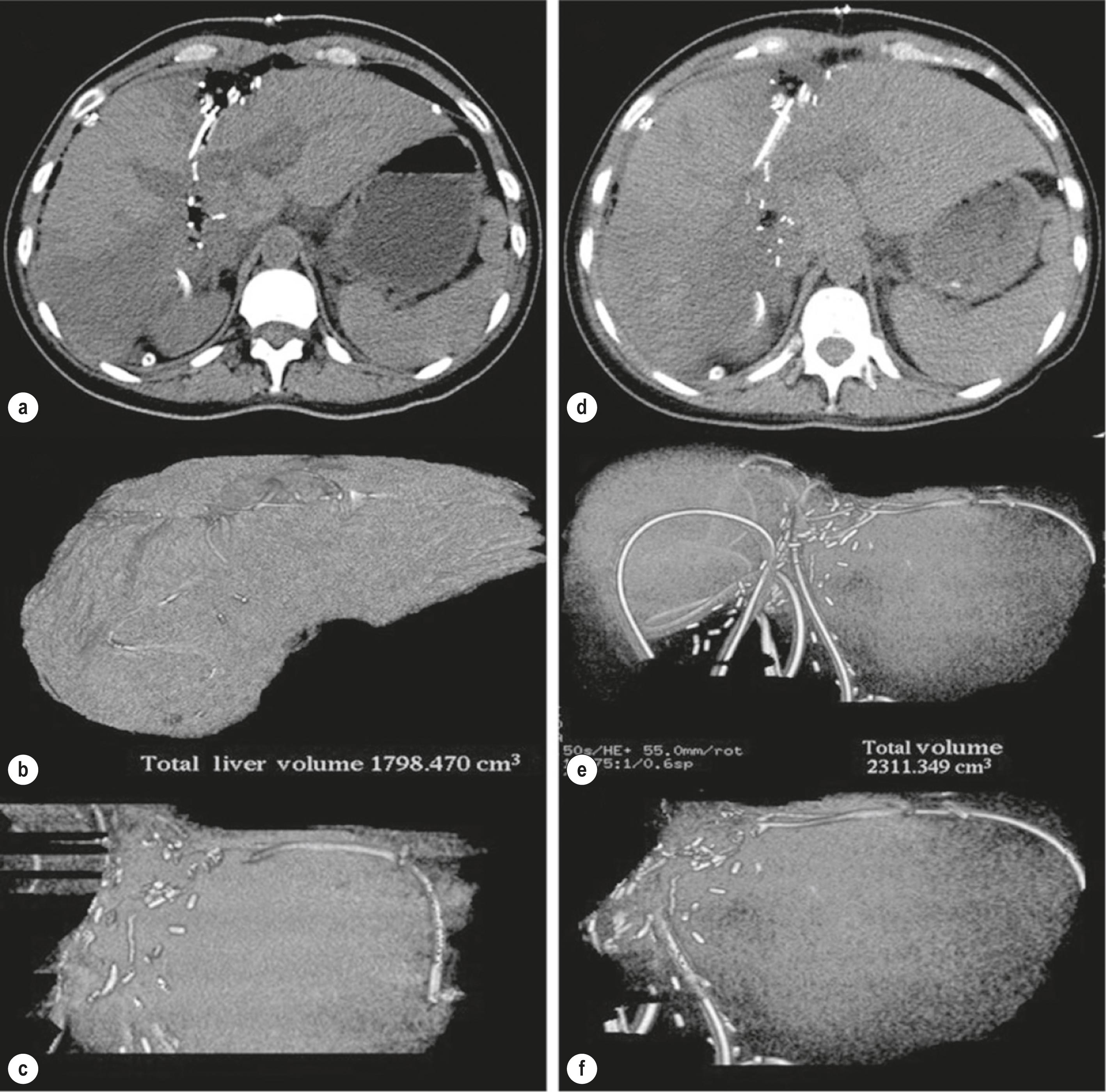 Figure 7.8, A 48-year-old female, with a history of rectal cancer and liver metastases underwent right portal vein ligation and in situ liver-splitting surgery. The postoperative axial (a) and volumetric computed tomography (CT) images of the liver (b, c) show total liver volume (TLV) = 1798 cm 3 (b) , and left liver volume (c) = 612 cm 3 . Axial (d) and volumetric CT images obtained after 1 week (e, f) show an increase in TLV to 2311 cm 3 (e) and left liver volume to 908 cm 3 (f) , corresponding to 35% increase in volume.