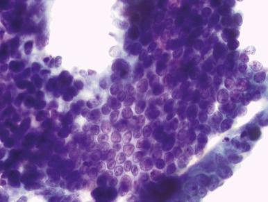 Fig. 14.1, Adenocarcinoma in situ. A large group with hyperchromatic nuclei and extreme crowding is seen, as well as a smaller group composed of a strip of columnar cells with polarized nuclei and focal apoptosis (ThinPrep).