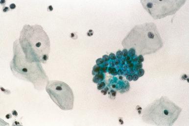 Fig. 14.11, Adenocarcinoma in situ. This small group might be confused with menstrual endometrial cells. However, they are well preserved, with vague feathering (conventional smear).