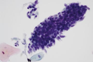 Fig. 14.12, Adenocarcinoma in situ. This group mimics directly sampled endometrium. Note the three-dimensional group, with overlapping nuclei and prominent feathering (ThinPrep).