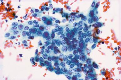 Fig. 14.13, Invasive adenocarcinoma. A sheet of cells with overlapping, similar-appearing nuclei with slightly coarse chromatin and small nucleoli is seen (conventional smear).