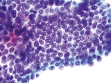 Fig. 14.15, Adenocarcinoma in situ. Although this honeycombed group, with cells having prominent nucleoli, superficially resembles reactive endocervical cells, there is irregular nuclear spacing, nuclear molding, anisonucleosis, and moderate nuclear coarsening as well. Also, note the mitotic figure at the lower left (ThinPrep).