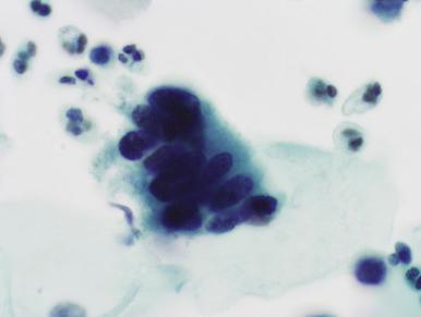 Fig. 14.16, Adenocarcinoma in situ. This small strip of columnar pseudostratified cells with coarse chromatin could easily be overlooked at scanning magnification as being normal endocervical cells (SurePath).