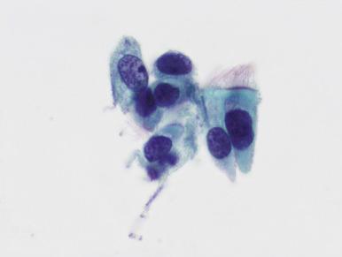 Fig. 14.17, Tubal metaplasia. With enlarged hyperchromatic nuclei, these cells may raise concern for glandular neoplasia. In this example, however, cilia are clearly evident (ThinPrep).