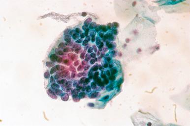 Fig. 14.18, Tubal metaplasia. Nuclei are crowded and hyperchromatic, similar to those of adenocarcinoma in situ. Note prominent cilia on the left-hand border. Feathering is absent (conventional smear).