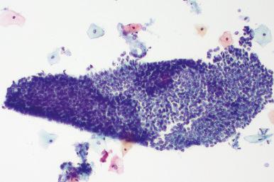 Fig. 14.19, Lower uterine segment, directly sampled. A sheet of cells simulating the appearance of adenocarcinoma in situ is present. Nuclei are less crowded than in the usual adenocarcinoma in situ (ThinPrep).