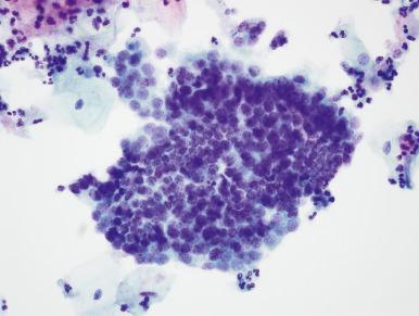 Fig. 14.20, Lower uterine segment, directly sampled. Although chromatin is slightly coarse, nuclei are small, uniform, and evenly dispersed (ThinPrep).