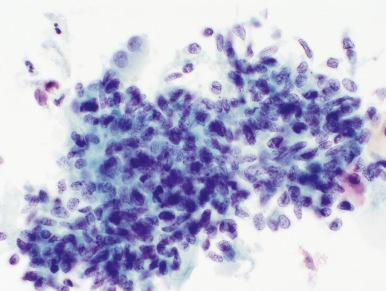 Fig. 14.21, Lower uterine segment, directly sampled. A fragment of spindled endometrial stromal cells with bland chromatin is seen (ThinPrep).