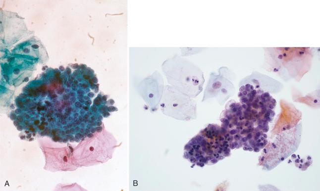 Fig. 14.22, A, Menstrual endometrial cells. A dark group of extremely crowded, small, degenerated nuclei has a vague suggestion of feathering (conventional smear). B, Menstrual endometrial cells. This three-dimensional group of cells with small crowded nuclei has some cells with vacuolated cytoplasm and others with more dense cytoplasm, which may create confusion with glandular or squamous neoplasia, respectively.