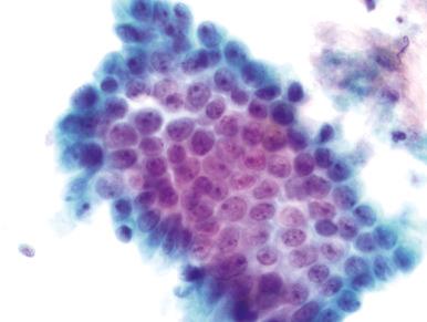 Fig. 14.23, Endocervical polyp. Nuclei are enlarged, with modest variation in size and prominent nuclei. However, cell spacing is uniform and chromatin is fine and evenly dispersed (ThinPrep).