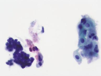 Fig. 14.26, Atrophy. This pseudoglandular arrangement of tightly bound nuclei may be confused with endometrial cells or carcinomas of various types, depending on the history. Note that the individual nuclei of the atrophic cells are similar to those in the squamous cells at right (ThinPrep).