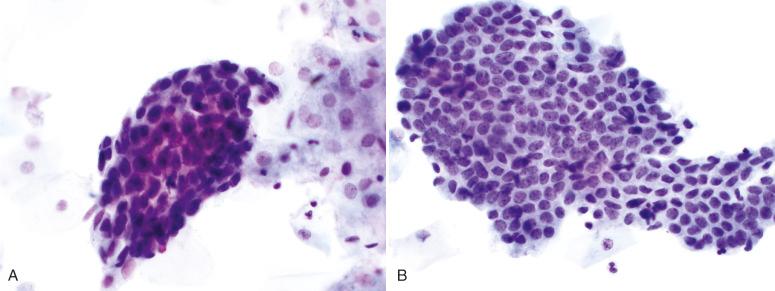 Fig. 14.27, High-grade squamous intraepithelial lesion. A, A three-dimensional group with crowded hyperchromatic nuclei simulates the appearance of adenocarcinoma in situ (AIS). There is a vague suggestion of feathering but no rosette formation or columnar cells present. In such cases, a high-grade squamous intraepithelial lesion (HSIL) is much more likely than AIS (ThinPrep). B, In this example, the low density of the cytoplasm and the honeycombed sheet suggest glandular neoplasia. However, clear-cut feathering or columnar shapes are absent (ThinPrep).