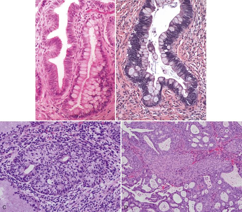 Fig. 14.29, Subpatterns of adenocarcinoma in situ. A, Adenocarcinoma in situ (AIS), intestinal type. Goblet cells are prominent. Ordinary (endocervical type) AIS is present in an adjacent crypt. B, AIS, pyloric type. C, AIS, stratified type. Cells are stratified; however, there is prominent intracytoplasmic mucin, including mucin vacuoles in the cells in all layers. D, Adenosquamous carcinoma in situ.