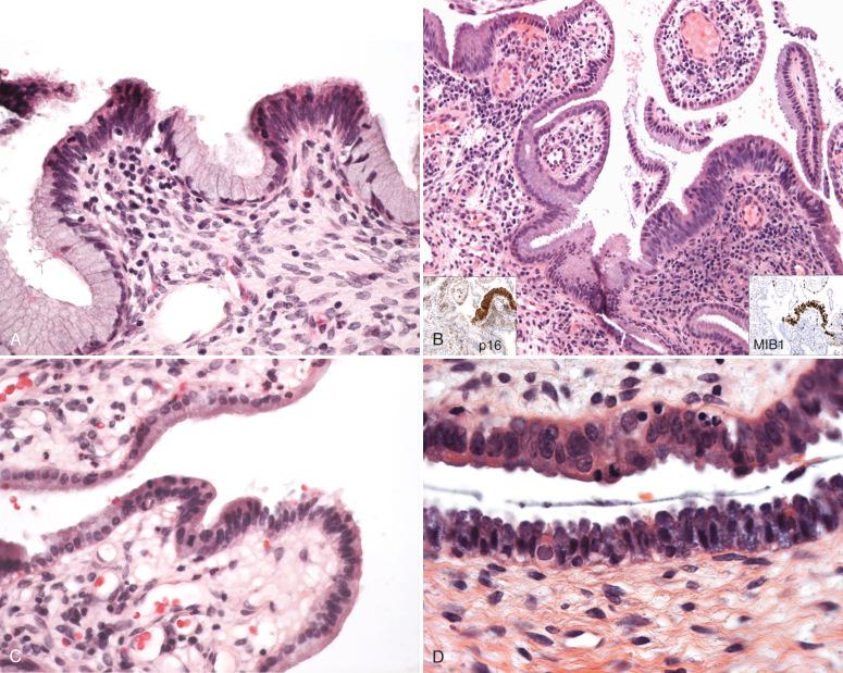 Fig. 14.30, A, Early adenocarcinoma in situ (AIS) typically develops in the tips of the endocervical papillae. B, Another example; note the strong staining for MIB-1 and p16 ( insets ) . C, A very subtle superficial AIS might be termed a lower grade intraepithelial neoplasia in earlier studies by Wells. D, This example of superficial (early) AIS (top) is rather subtle but recognizable with attention to cytologic detail.