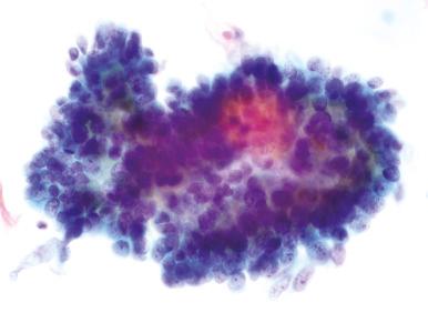 Fig. 14.4, Adenocarcinoma in situ. Nuclear crowding with moderately coarse chromatin, slight feathering, and rosette formation are present (ThinPrep).