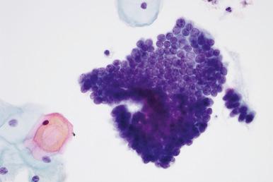 Fig. 14.5, Adenocarcinoma in situ. Nuclear crowding with a rosette-like structure is present. Nuclei are only slightly hyperchromatic in this example (ThinPrep).