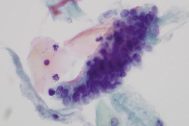 Fig. 14.6, Adenocarcinoma in situ. This strip of crowded pseudostratified columnar cells has only a vague suggestion of feathering and moderately hyperchromatic nuclei (ThinPrep).