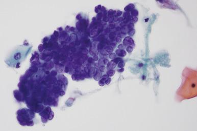 Fig. 14.7, Invasive adenocarcinoma. This adenocarcinoma in situ–like group has pronounced nuclear overlap, nuclear molding, anisonucleosis, and scattered apoptotic figures. There was microinvasion in the biopsy, but this could not have been anticipated from the cytologic findings (ThinPrep).