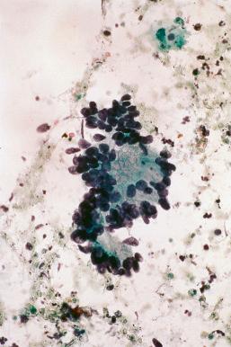 Fig. 14.8, Invasive adenocarcinoma. Degenerated nuclear fragments are present in the background. The group has an adenocarcinoma in situ (AIS)–like appearance and would be difficult to distinguish from AIS in the absence of the background diathesis. A diathesis, however, cannot be relied on to confirm invasion because it is rarely present in early invasive adenocarcinoma of the cervix (conventional smear).