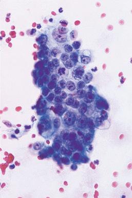 Fig. 14.9, Invasive adenocarcinoma. Shown are crowded enlarged nuclei with prominent nucleoli and mitotic figures. The cytoplasm is foamy and focally vacuolated (conventional smear).