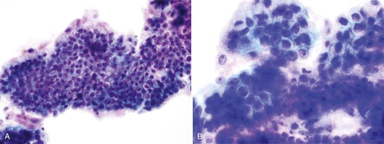Fig. 14.10, Invasive adenocarcinoma. A, At low power, this sheet of glandular cells with abundant mucin could be mistaken for reactive endocervical cells. B, At high power, a monotonous appearance to the cells, each having a single prominent nucleolus, is more readily appreciated (ThinPrep).