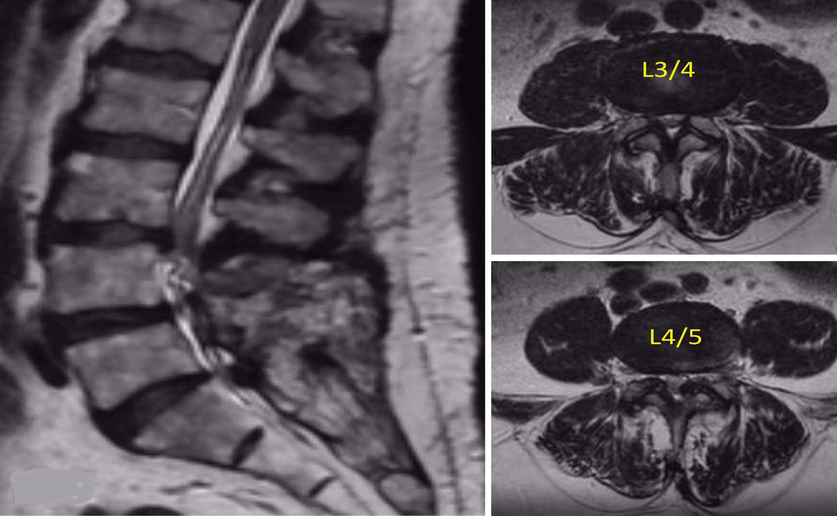 Fig. 17.1, Sagittal and axial T2-weighted MRI demonstrating central, lateral recess, and foraminal stenosis at the L3/4 and L4/5 levels. The stenosis was caused by a combination of disk bulge, ligamentum flavum hypertrophy, and facet arthropathy.