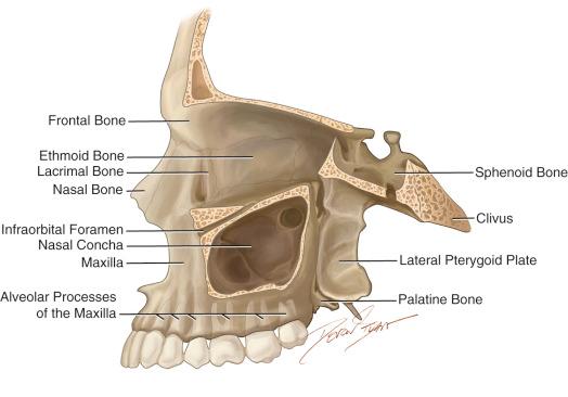 Figure 30.1, Lateral view of important maxillary sinus structures.