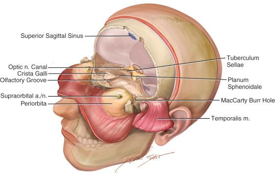 Figure 30.2, The anterior cranial fossa structures showing the cribriform plate, olfactory groove, crista galli, the planum sphenoidale, tuberculum sellae, optic nerve canal and McCarty burr hole.