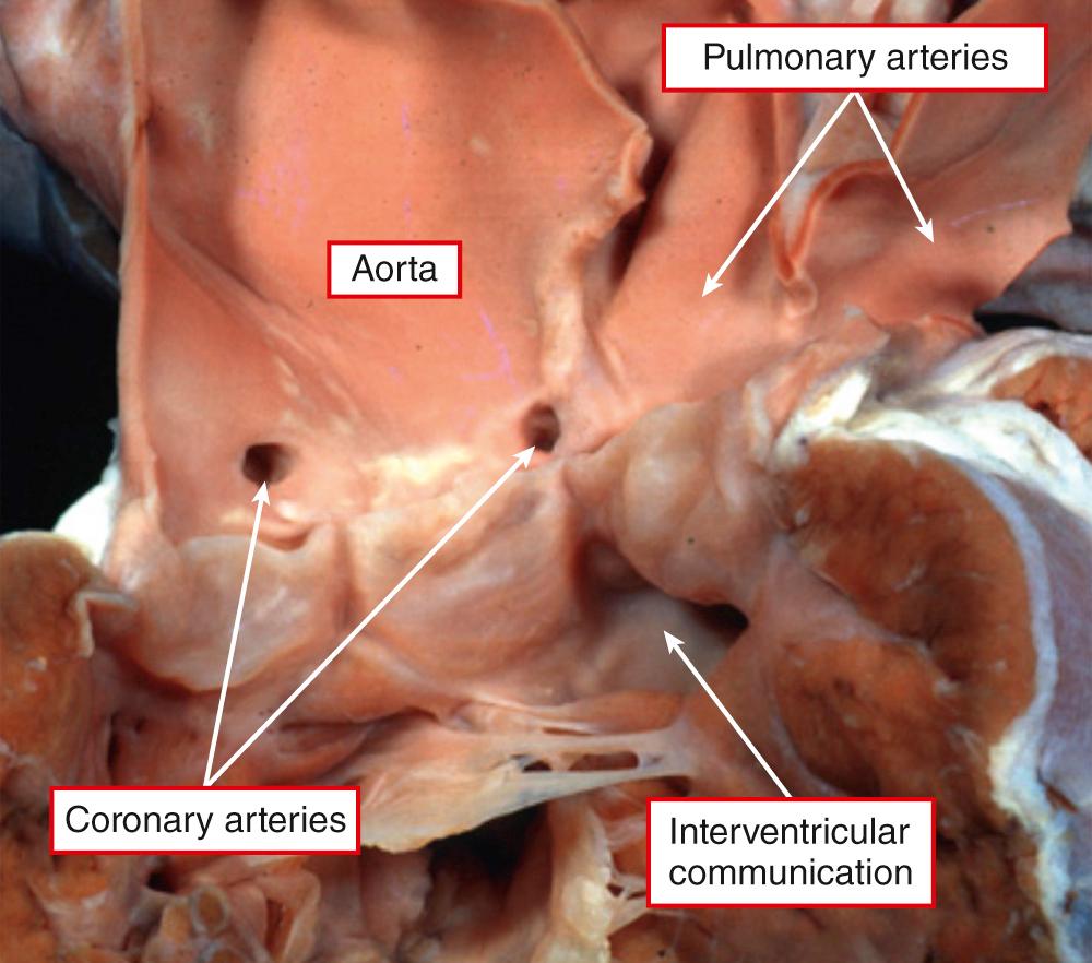 Fig. 40.1, Common arterial trunk exiting from the ventricular mass through a common ventriculoarterial junction guarded by a common arterial valve and supplying directly the coronary, systemic, and pulmonary circulations.