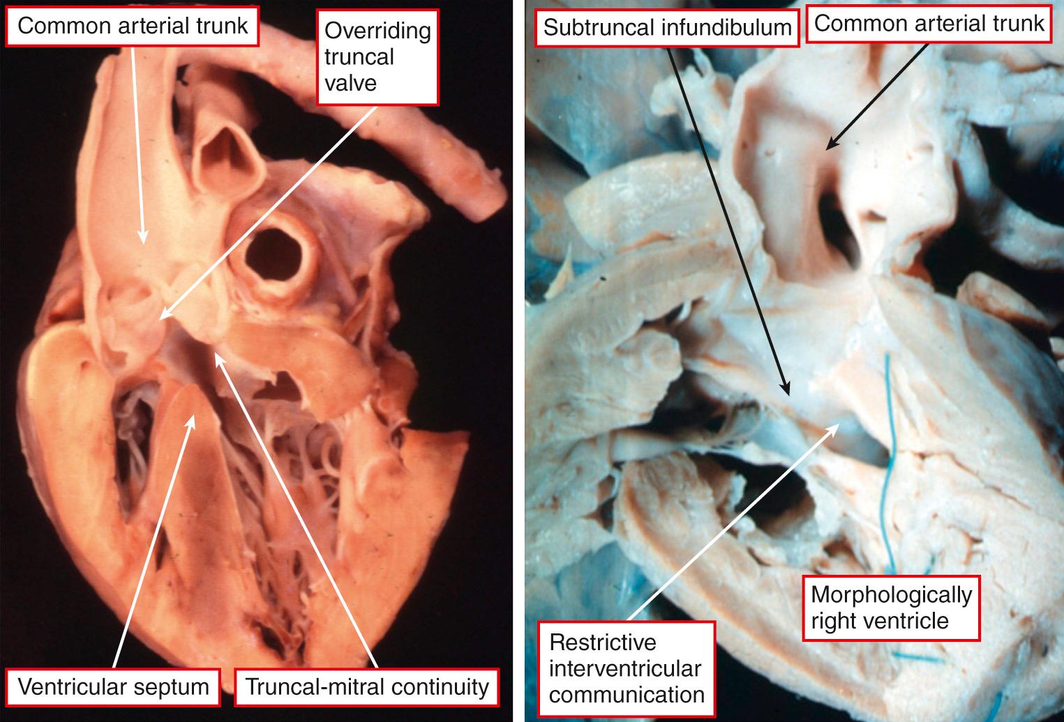 Fig. 40.3, Left, Heart sectioned to replicate the parasternal long axis echocardiographic section. It shows the truncal valve overriding the crest of the muscular ventricular septum, with the valvar leaflets supported in both ventricles. Note the fibrous continuity between the leaflets of the tricuspid and mitral valves. Right, In contrast, this heart has the trunk exclusively supported above the morphologically right ventricle, with a completely muscular subtruncal infundibulum.