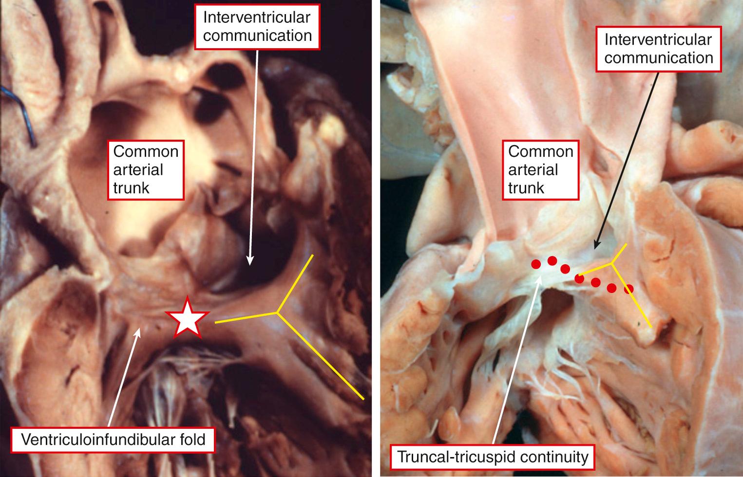 Fig. 40.4, The presence or absence of a muscular rim along the posteroinferior margin of the interventricular communication determines whether the defect is considered to be perimembranous. Left, The ventriculoinfundibular fold fuses with the posteroinferior limb of the septomarginal trabeculation (yellow bars) . The muscular bar thus formed (star) protects the atrioventricular conduction axis during surgical correction. Right, Defect with fibrous continuity between the leaflets of the truncal and tricuspid valves, putting conduction axis (dotted line) at potential risk during surgical correction.