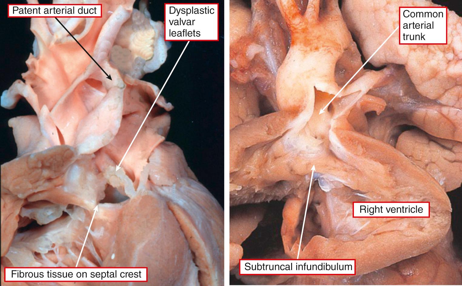 Fig. 40.5, Left, Dysplastic leaflets of the common truncal valve closed on the crest of the ventricular septum during ventricular diastole; the crest itself is thickened by fibrous tissue. However, an interventricular communication remains during ventricular systole. Note the persistently patent arterial duct. This heart has a balanced arrangement of the intrapericardial components of the aorta and the pulmonary trunk. Right, In contrast, this trunk arises exclusively from the right ventricle, and the ventricular septum is intact. This heart has aortic dominance but with a confluent pulmonary arterial segment.