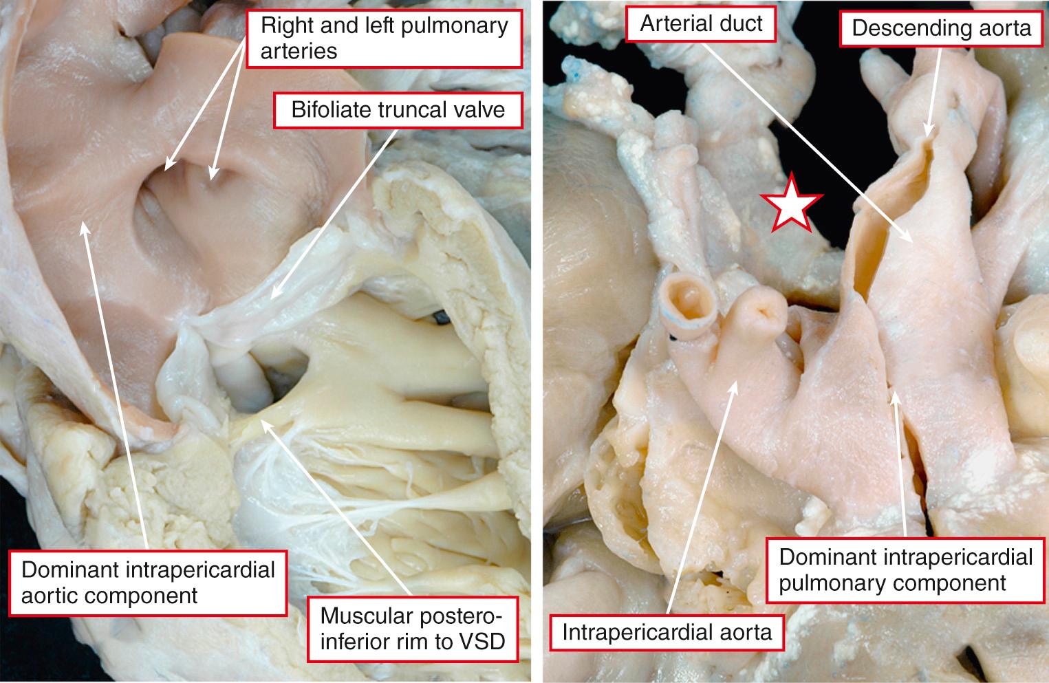 Fig. 40.6, According to the pattern of branching of the common trunk, cases can usually be described in terms of aortic (left) or pulmonary (right) dominance. Note the interruption of the aortic arch (star) in the heart shown at right, with retroesophageal origin the right subclavian artery. In rare circumstances, there can be a balanced pattern of branching (see Fig. 40.5 , left ). VSD, Ventricular septal defect.