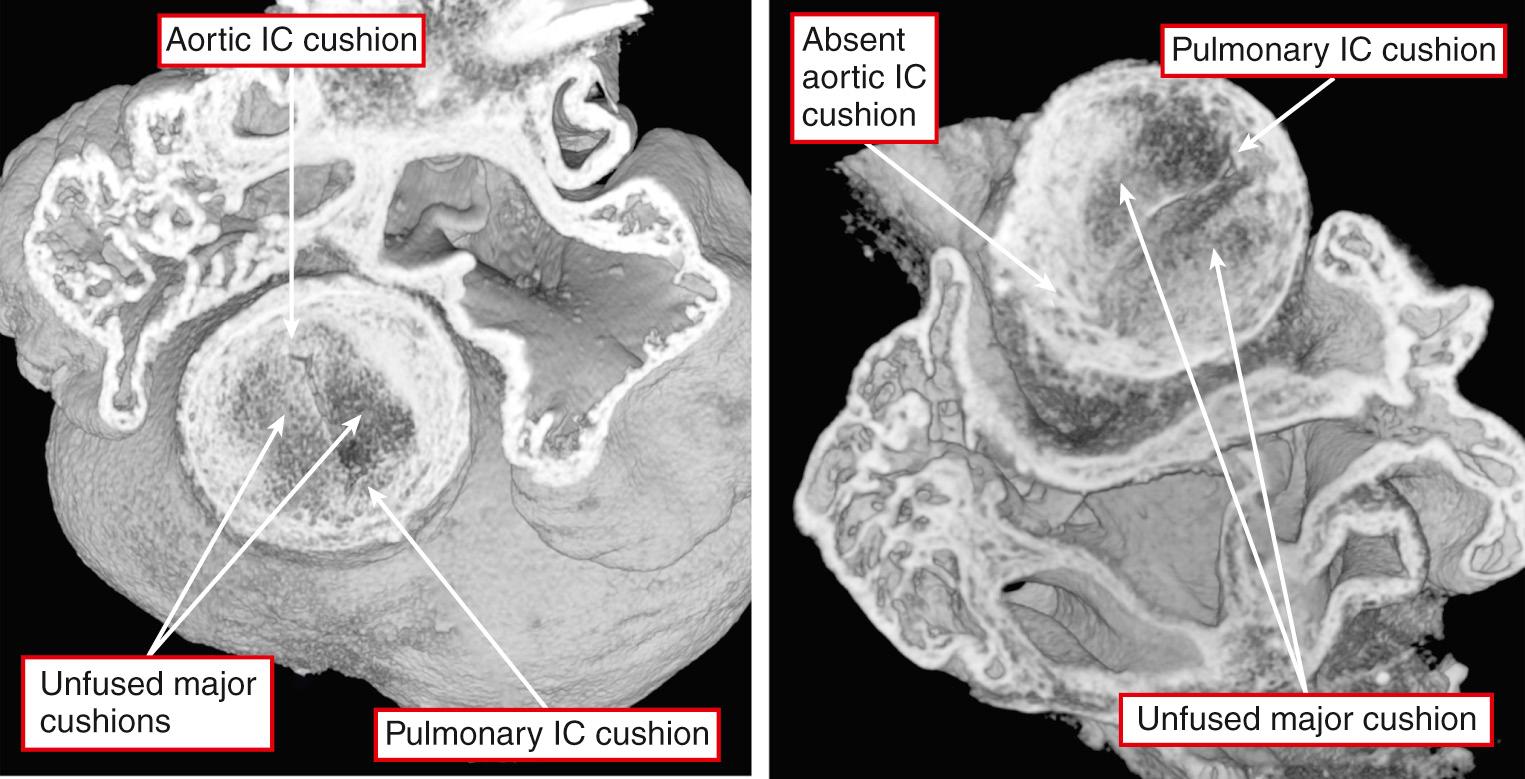 Fig. 40.7, Ventriculoarterial junctions of two mouse embryos in which the Furin enzyme was perturbed. Both have common arterial trunk (see Fig. 40.8 ). Left, Two major outflow cushions have failed to fuse, but with normal formation of the intercalated (IC) cushions. The situation will produce a quadrifoliate truncal valve. The heart is photographed from above. Right, Failure of fusion of the outflow cushions, but with absence of the aortic IC cushion, providing the potential for forming a trifoliate truncal valve. This heart is photographed from the apex looking toward the cardiac base.