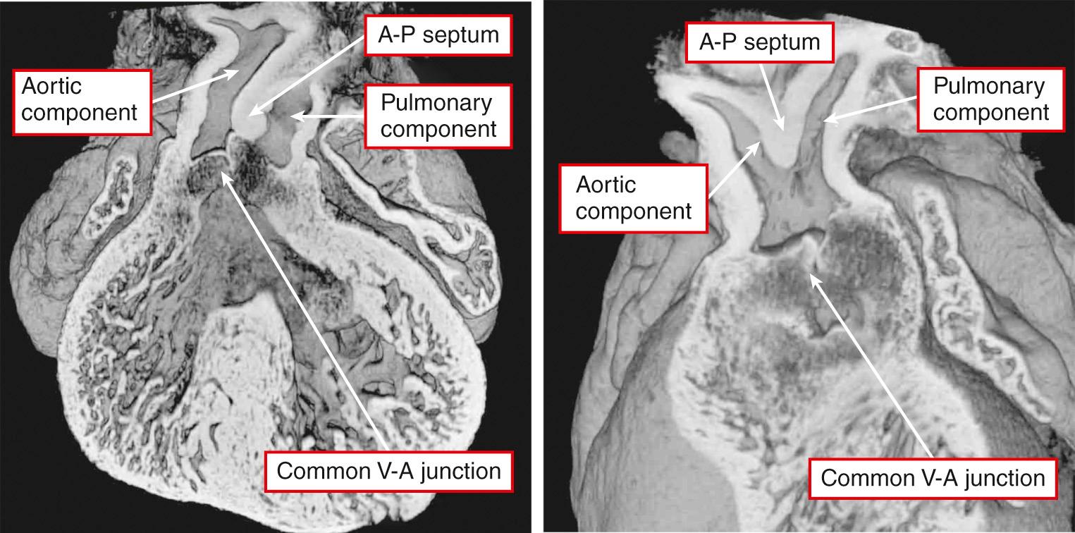 Fig. 40.8, Hearts from mice in which the Furin enzyme was perturbed. Both hearts have common arterial trunk, but there is a balanced arrangement of the aortic and pulmonary components of the common trunk in the heart shown at left, whereas the heart at right shows a mouse with pulmonary dominance and interruption of the aortic arch.