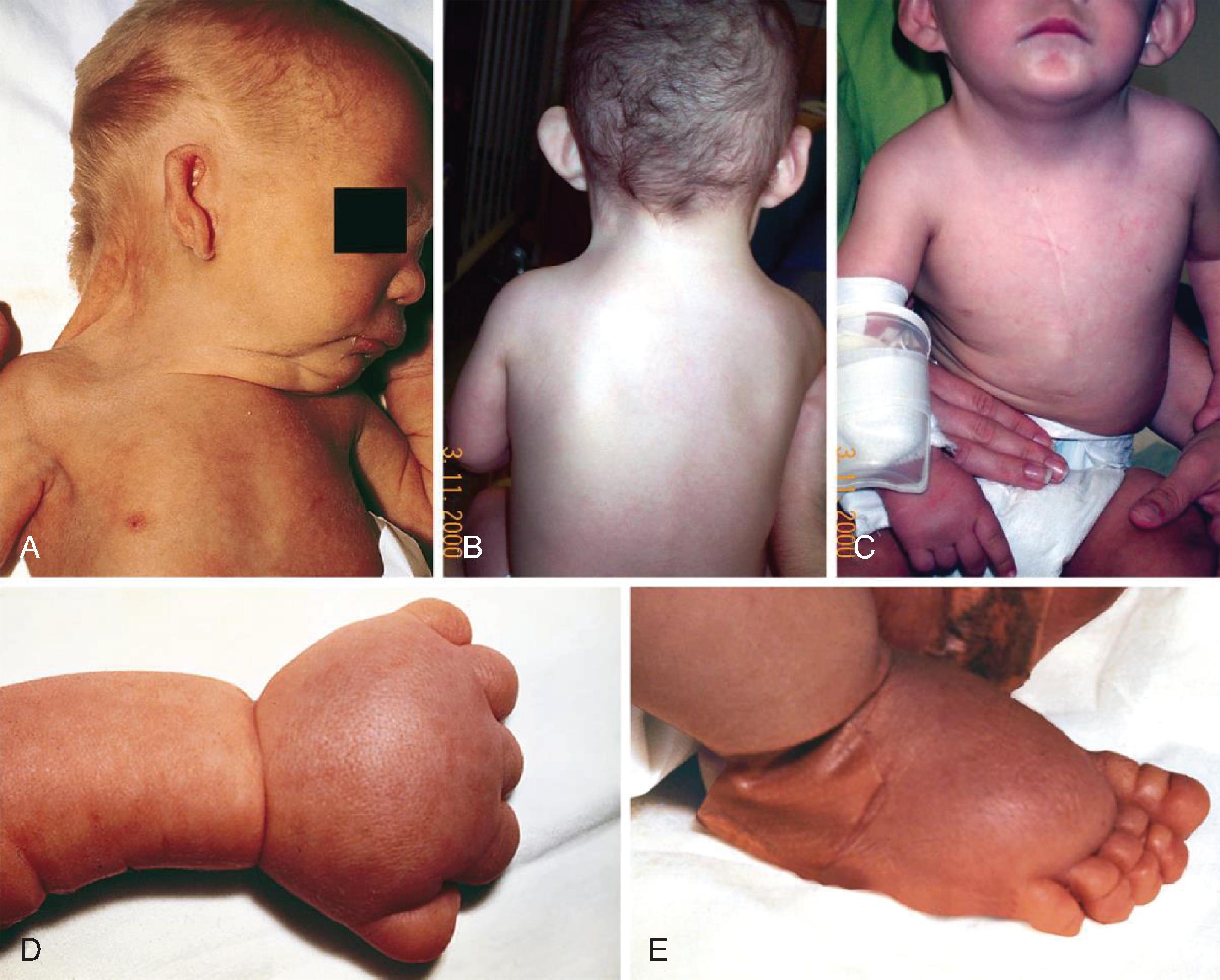 Fig. 80.2, Physical Manifestations Associated With Turner Syndrome .