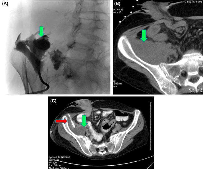 Common Complications of Surgery for Crohn's Disease and Ulcerative ...