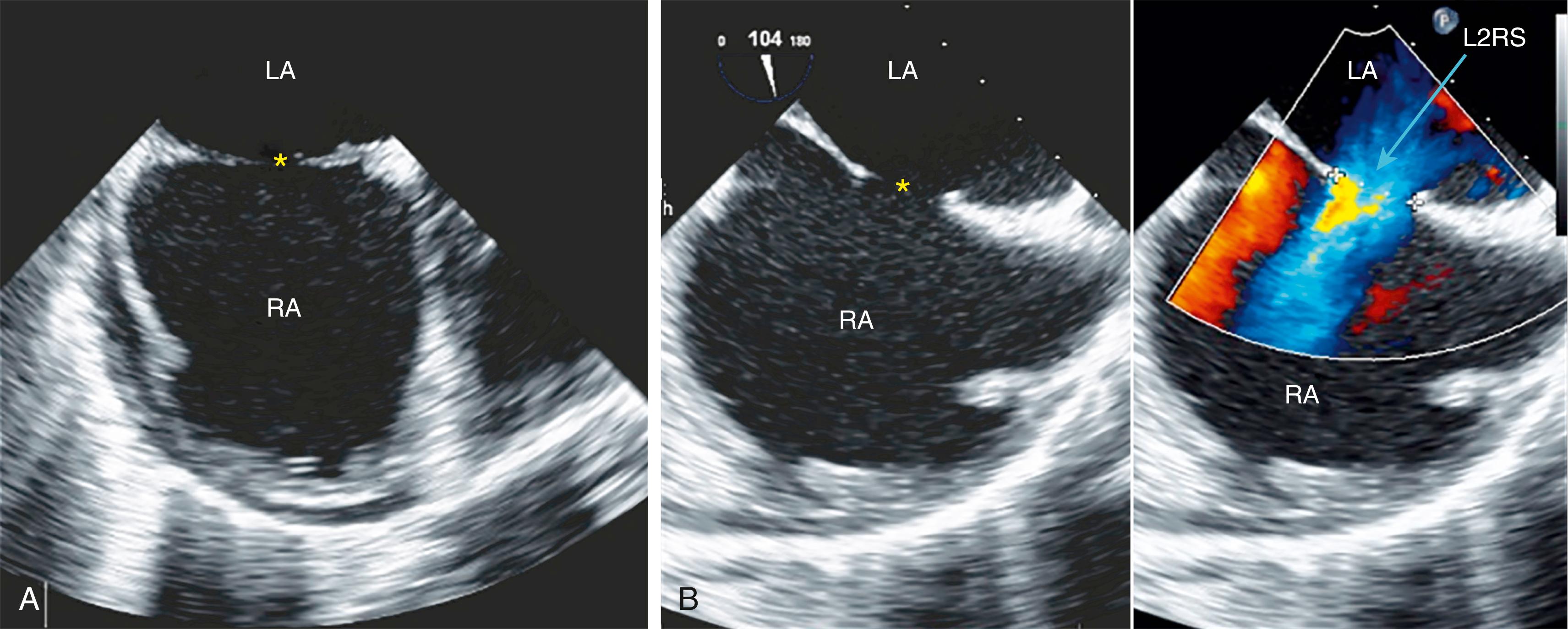Figure 141.1, Secundum atrial septal defect (asterisk) visualized in the short-axis ( A ) and long-axis ( B ) views by transesophageal echocardiography. Color Doppler imaging shows the left-to-right shunt (L2RS). LA, Left atrium; RA, right atrium.