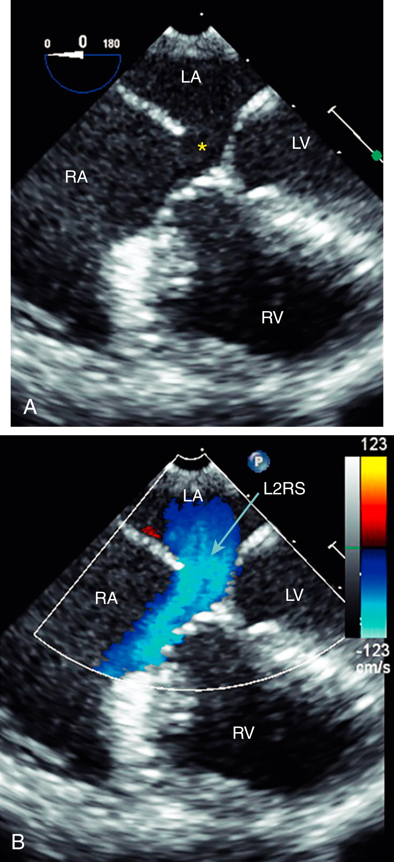 Figure 141.2, A, Primum atrial septal defect (asterisk) visualized in the midesophageal four-chamber view by transesophageal echocardiography. B, Color Doppler imaging shows the left-to-right shunt (L2RS). LA, Left atrium; LV , left ventricle; RA, right atrium; RV, right ventricle. (See accompanying Video 141.2 )