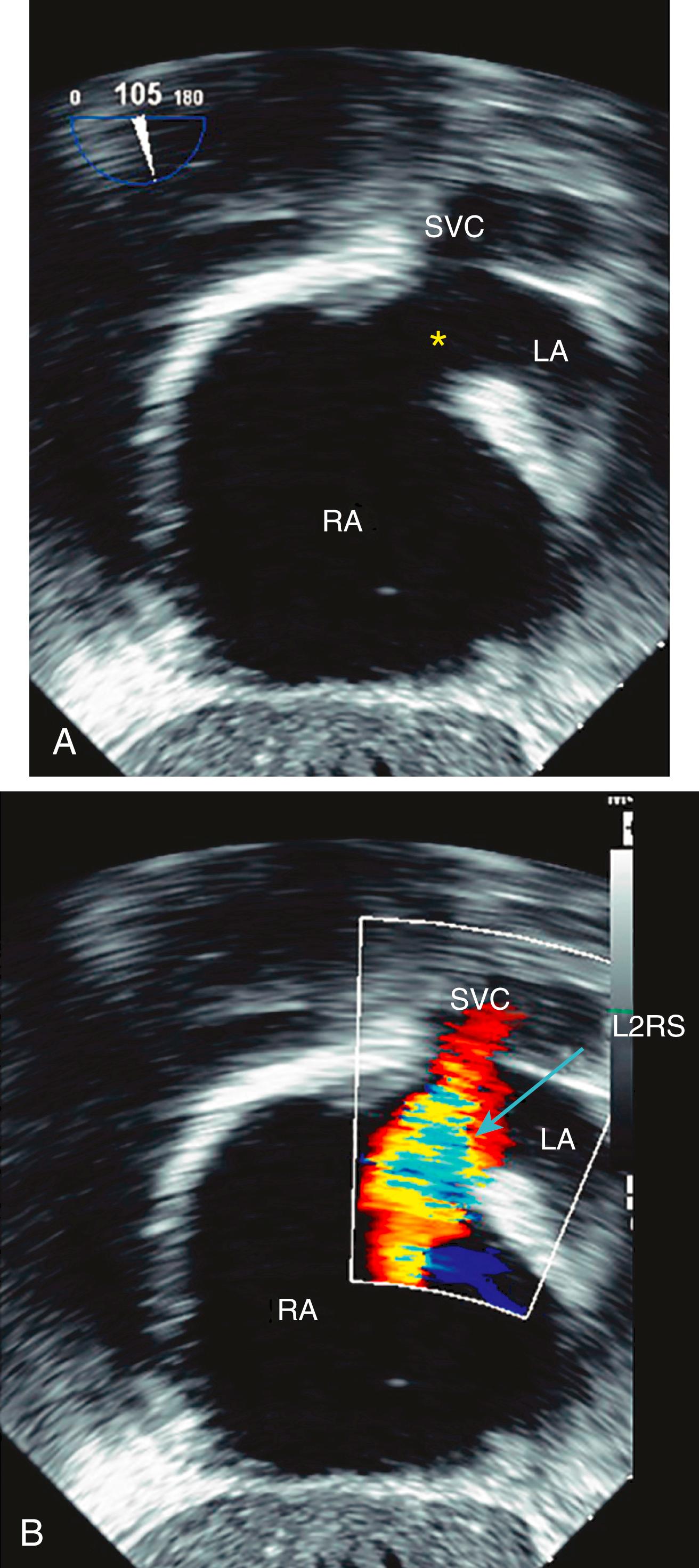 Figure 141.3, A, Superior sinus venosus atrial septal defect (asterisk) visualized in the transgastric view by transesophageal echocardiography. B, Color Doppler imaging shows the left-to-right shunt (L2RS). LA, Left atrium; RA, right atrium; SVC, superior vena cava. (See accompanying Video 141.3 )