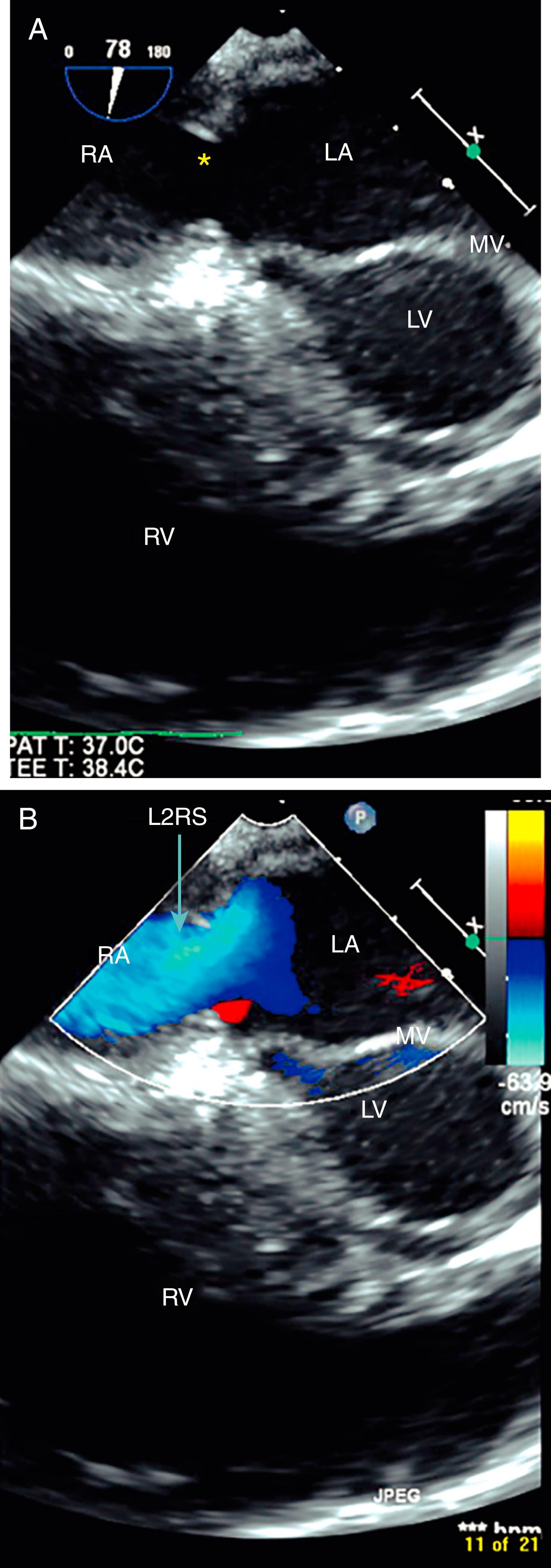 Figure 141.4, A, Coronary sinus atrial septal defect (asterisk) visualized by transesophageal echocardiography. B, Color Doppler imaging shows the left-to-right shunt (L2RS). LA, Left atrium; LV, left ventricle; MV, mitral valve; RA, right atrium; RV, right ventricle. (See accompanying Video 141.4 )