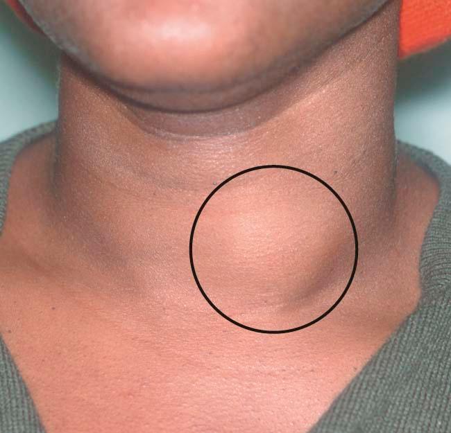 FIGURE 16-1, A goiter caused by iodine deficiency in a pregnant woman (circle) . Although iodine deficiency is rare during pregnancy, it can occur in areas where preconception and prenatal care are inadequate.