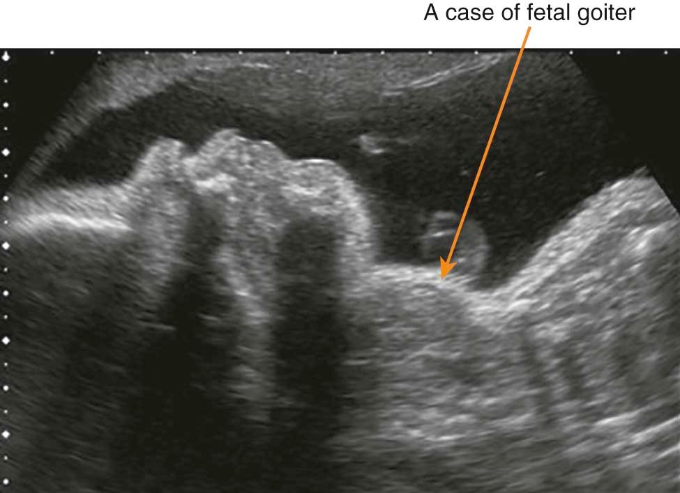 FIGURE 16-2, Ultrasonic study of a fetus with a goiter caused by maternal treatment with propylthiouracil for hyperthyroidism.