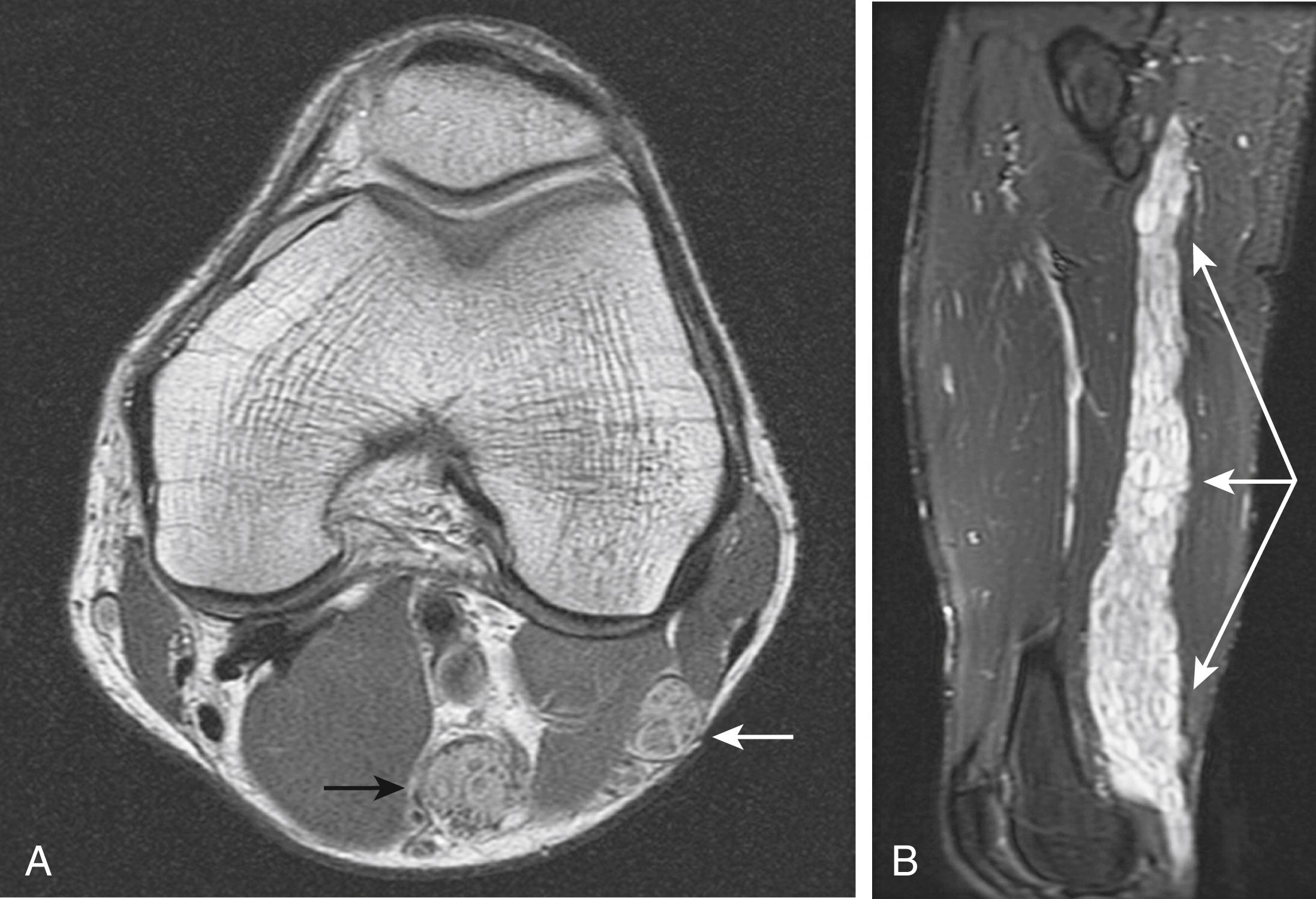FIG. 172.1, A, Axial proton density-weighted image demonstrates markedly enlarged fascicles of both the tibial (black arrow) and common peroneal (white arrow) nerves because of plexiform neurofibromas. B, Large field-of-view sagittal fat-suppressed T2-weighted image in the same patient reveals extensive plexiform neurofibromas throughout the length of the sciatic nerve (arrows) .