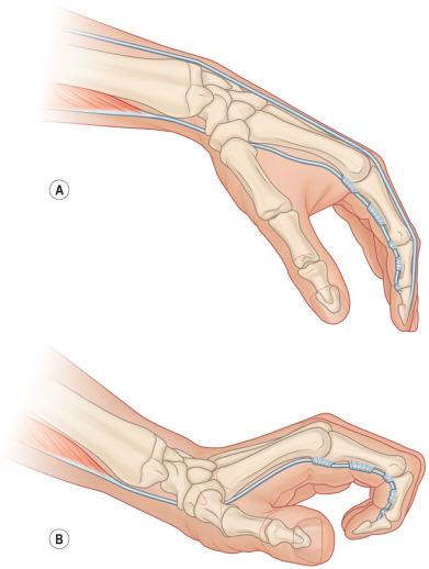 FIG. 5.6.1, The wrist tenodesis effect increases tendon excursion. Wrist flexion (A) and extension (B) can increase the amplitude of finger extension and flexion by 2.5 cm, respectively.