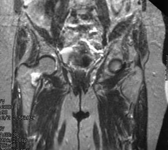 Fig. 10.1, A T2-weighted magnetic resonance image showing a medial femoral neck stress fracture.